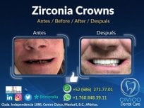 نتيجة قبل وبعد تيجان الزركونيا في CIVICO DENTAL CARE MEXICALI، استعادة الابتسامة