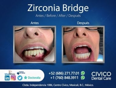 نتائج قبل وبعد جسر الأسنان الزركوني في CIVICO DENTAL CARE MEXICALI، ابتسامة مستعادة