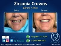 نتيجة قبل وبعد تركيب تيجان الزركونيا في CIVICO DENTAL CARE MEXICALI، استعادة الابتسامة