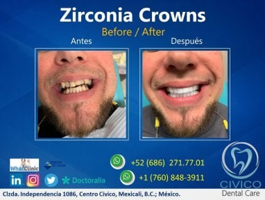 نتيجة قبل وبعد تيجان الزركونيا في CIVICO DENTAL CARE MEXICALI، استعادة الابتسامة