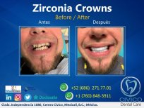 نتيجة قبل وبعد تيجان الزركونيا في CIVICO DENTAL CARE MEXICALI، استعادة الابتسامة