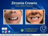 نتيجة قبل وبعد تركيب تيجان الزركونيا في CIVICO DENTAL CARE MEXICALI، استعادة الابتسامة