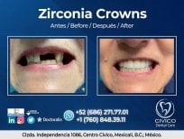 نتيجة قبل وبعد تيجان الزركونيا في CIVICO DENTAL CARE MEXICALI، ترميم الابتسامة
