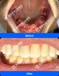 Résultats avant et après implants dentaires à Wuhan Yiya Simei Dental Hospital, sourire restauré