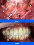 Résultats avant et après implants dentaires à Wuhan Yiya Simei Dental Hospital, sourire restauré