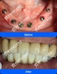 Résultats avant et après implants dentaires à Wuhan Yiya Simei Dental Hospital, sourire restauré