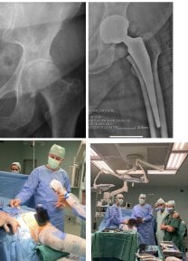 Ergebnisse der Hüfttotalendoprothese in der Dr Andreas Papadopoulos Sports Medicine and Joint Reconstruction Clinic