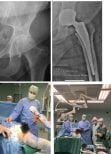 Ergebnisse der Hüfttotalendoprothese in der Dr Andreas Papadopoulos Sports Medicine and Joint Reconstruction Clinic