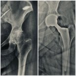 Vorher-nachher-Ergebnisse der Hüfttotalendoprothese in der Klinik Dr Andreas Papadopoulos