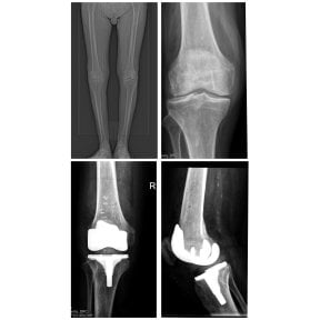 Vorher-nachher-Röntgenergebnisse Knieprothese in Dr. Andreas Papadopoulos Klinik