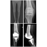 Vorher-nachher-Röntgenergebnisse Knieprothese in Dr. Andreas Papadopoulos Klinik