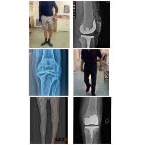 Vorher-nachher-Ergebnisse Knieprothese bei Dr Andreas Papadopoulos Sports Medicine Clinic