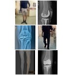 Vorher-nachher-Ergebnisse Knieprothese bei Dr Andreas Papadopoulos Sports Medicine Clinic