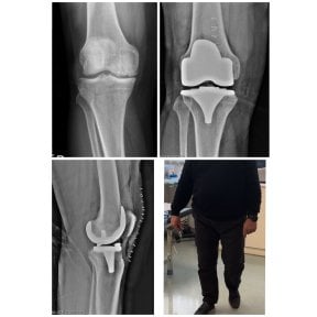 Vorher-nachher-Ergebnisse Knieprothese bei Dr Andreas Papadopoulos Klinik