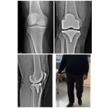 Vorher-nachher-Ergebnisse Knieprothese bei Dr Andreas Papadopoulos Klinik