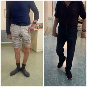 Vorher-nachher-Ergebnisse der Knieoperation in der Dr Andreas Papadopoulos Sports Medicine Klinik
