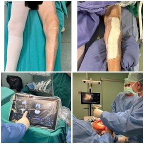 Ablauf und Ergebnisse der Knieprothese in der Dr Andreas Papadopoulos Klinik