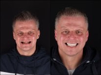 Before and after All-on-4 dental implants result at RIKOTA Dental Clinic, full smile restoration