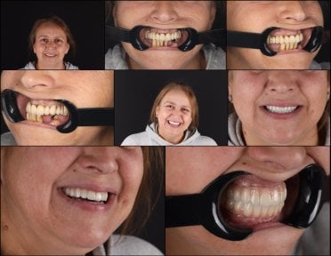 Before and after All-on-4 dental implants result at RIKOTA Dental Clinic, full smile restoration