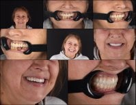 Before and after All-on-4 dental implants result at RIKOTA Dental Clinic, full smile restoration