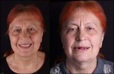 Before and after All-on-4 dental implants result at RIKOTA Dental Clinic, restored smile