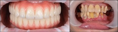 Before and after All-on-4 dental implants result at RIKOTA Dental Clinic, full smile restoration