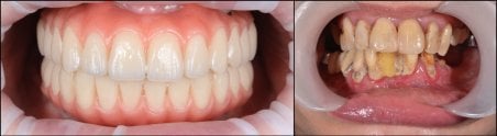 Before and after All-on-4 dental implants result at RIKOTA Dental Clinic, full smile restoration