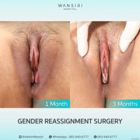 Vorher-nachher-Ergebnisse der Geschlechtsangleichung in Wansiri Hospital, 1 und 3 Monate