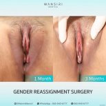 Vorher-nachher-Ergebnisse der Geschlechtsangleichung in Wansiri Hospital, 1 und 3 Monate