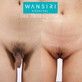 Vorher-nachher-Ergebnis der Mann-zu-Frau-Geschlechtsangleichung in Wansiri Hospital