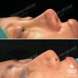 نتائج تجميل الأنف للرجال قبل وبعد في مستشفى لوكمان حكيم إسطنبول، إعادة تشكيل الأنف