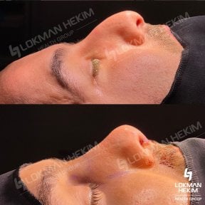 نتائج تجميل الأنف للرجال قبل وبعد في مستشفى لقمان حكيم إسطنبول، تحسين شكل الأنف