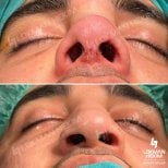 نتائج تجميل الأنف للرجال قبل وبعد في مستشفى لوكمان حكيم إسطنبول، تحسين شكل الأنف