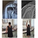 Vorher-nachher-Ergebnisse Schulterprothese in Dr. Andreas Papadopoulos Sportmedizin Klinik