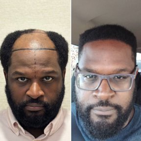Resultados de trasplante de cabello afro antes y después en Este Favor Hair Transplant Center, línea restaurada