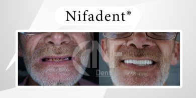 Before and after All-on-4 dental implants result at Nifa Dent International – smile restoration