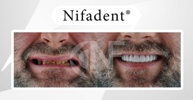 Before and after All-on-4 dental implants result at Nifa Dent International, smile restoration