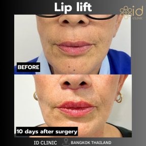 before-after photo rhinoplasty-nose-job
