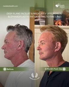 Before and after deep plane facelift results at Dr. Safa Manav Clinic, 8 months post-op