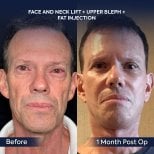 Before and after face and neck lift with upper blepharoplasty at Dr. Safa Manav Clinic results