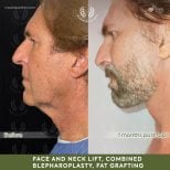 Before and after face and neck lift, blepharoplasty, fat grafting results at Medolea Clinic