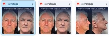 Before and after face and neck lift with blepharoplasty at Dr. Safa Manav Clinic, visible results