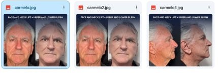 Before and after face and neck lift with blepharoplasty at Dr. Safa Manav Clinic, visible results