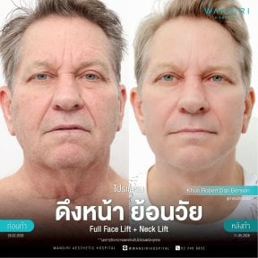 before-after photo deep-plane-facelift
