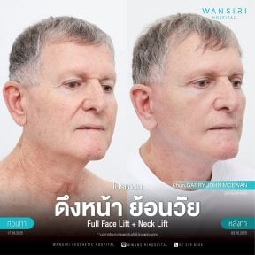 before-after photo deep-plane-facelift