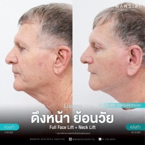 before-after photo deep-plane-facelift