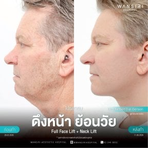 before-after photo deep-plane-facelift