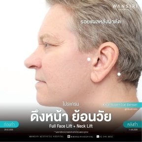 before-after photo deep-plane-facelift