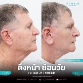 before-after photo deep-plane-facelift