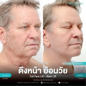 before-after photo deep-plane-facelift